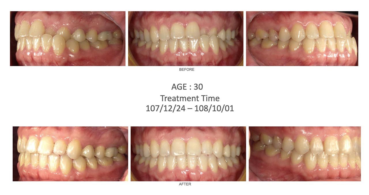 隱適美Lite輕矯正前後咬合變化