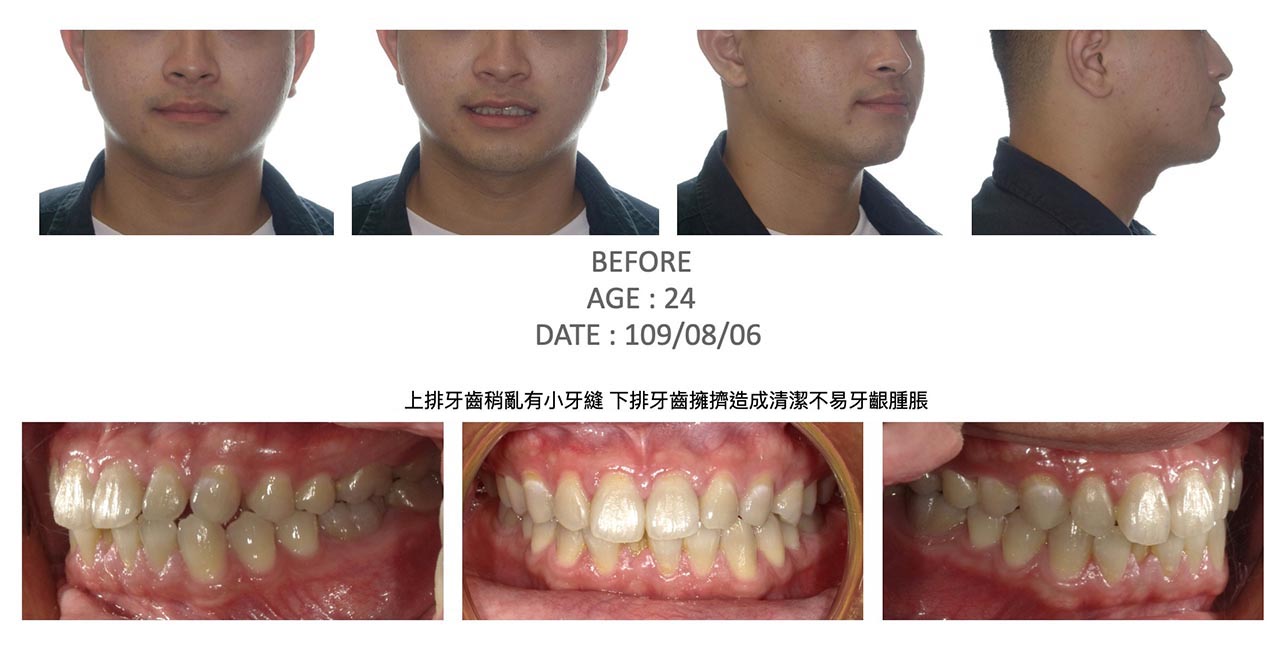 隱適美Lite輕矯正前的各角度臉型及咬合近照,上排牙齒稍亂有小牙縫、下排牙齒擁擠造成清潔不易、牙齦腫脹