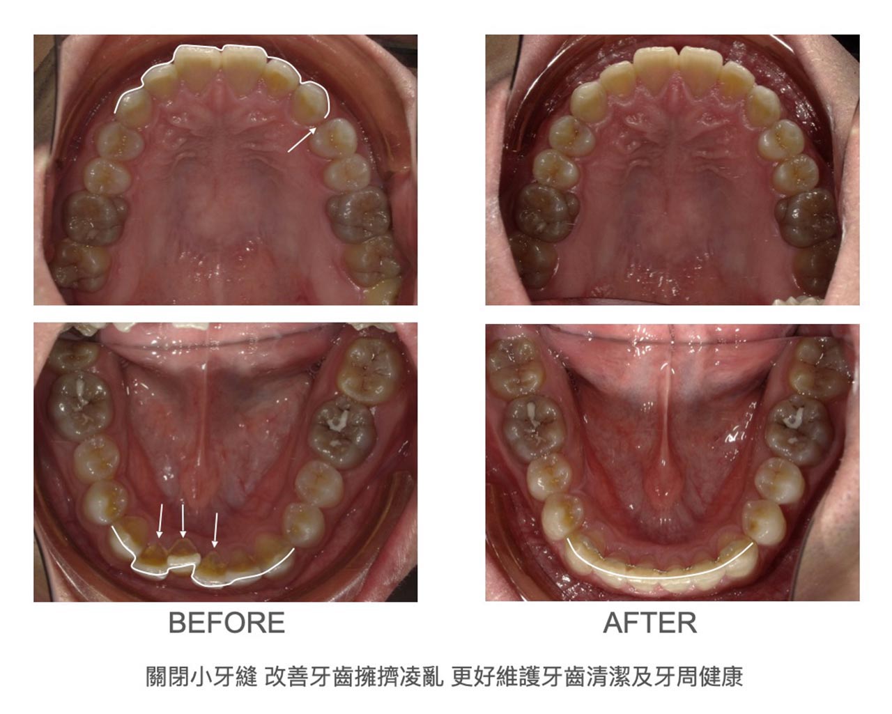 隱適美Lite輕矯正前後上下排牙弓形狀變化,關閉上排小牙縫並改善下排牙齒擁擠,更好維護牙齒清潔與牙周健康