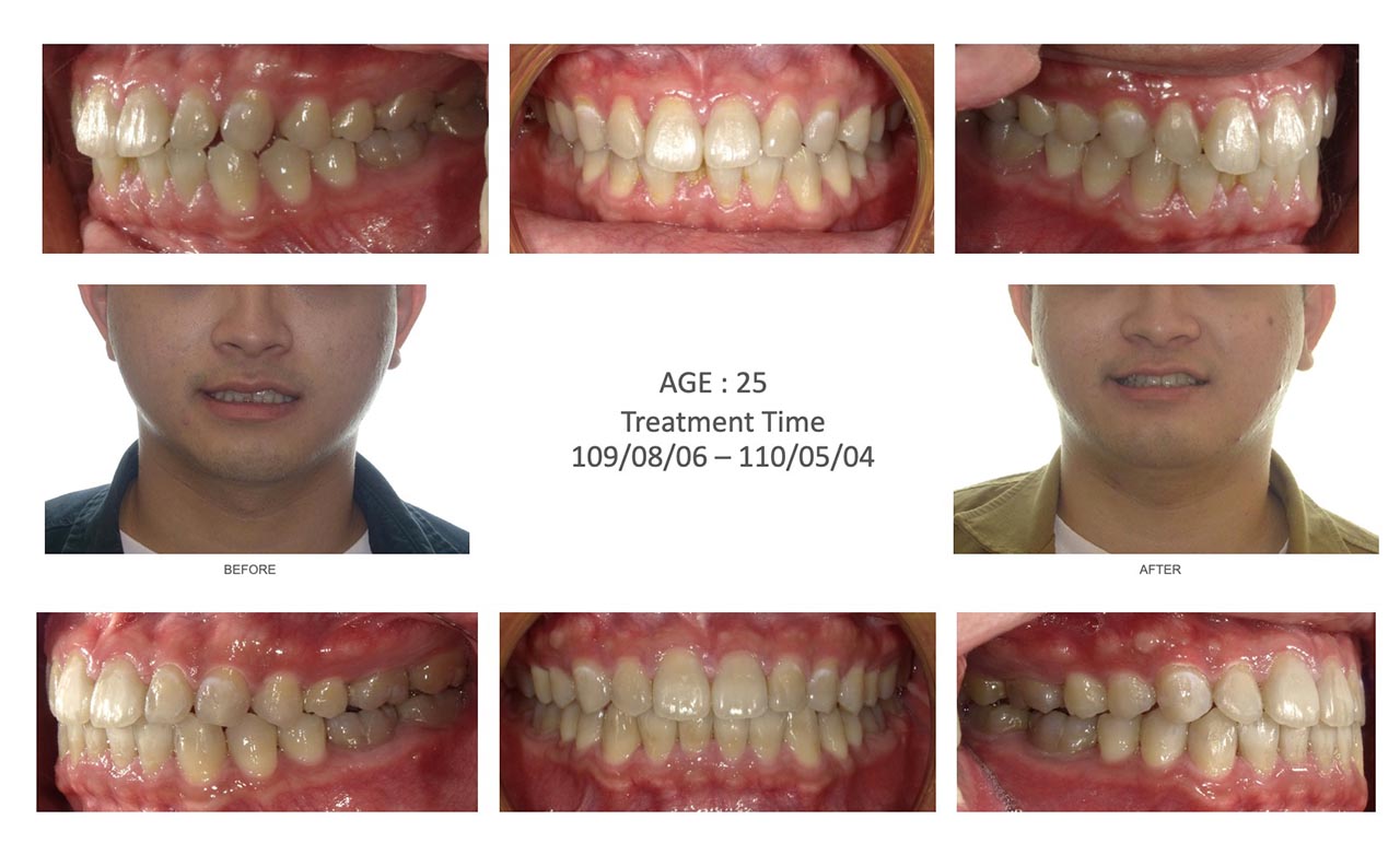 隱適美Lite輕矯正前後笑容臉型及咬合變化