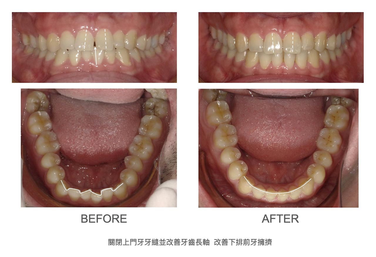 隱適美Lite輕矯正前後牙弓形狀與門牙變化，關閉上門牙牙縫並改善牙齒長軸、下排前牙牙齒擁擠