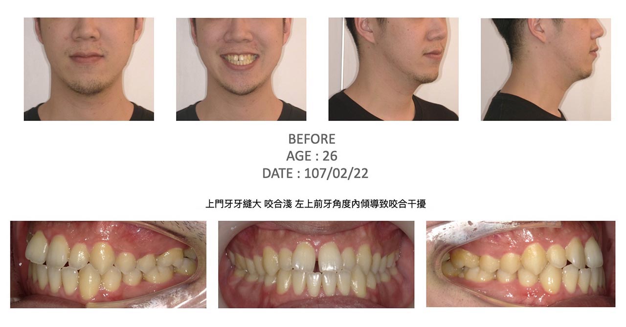 隱適美Lite輕矯正前的各角度臉型及咬合近照,有上門牙牙縫大、咬合淺、左上前牙牙齒內傾導致咬合干擾等問題
