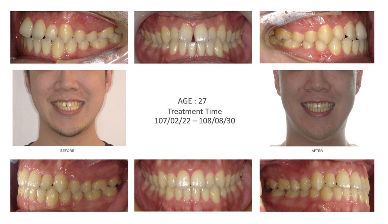 隱適美Lite輕矯正前後笑容臉型及咬合變化