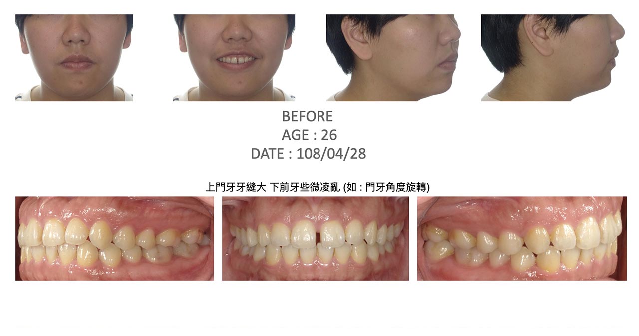 隱適美Lite輕矯正前的各角度臉型及咬合近照,有上門牙牙縫大、下前牙些微凌亂(如 : 門牙角度旋轉)等問題