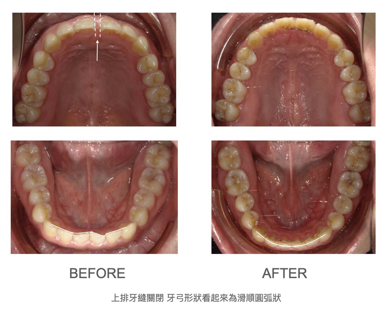 隱適美Lite輕矯正前後上下排牙弓變化,關閉上門牙縫、下排牙齒排齊後牙弓形狀更滑順