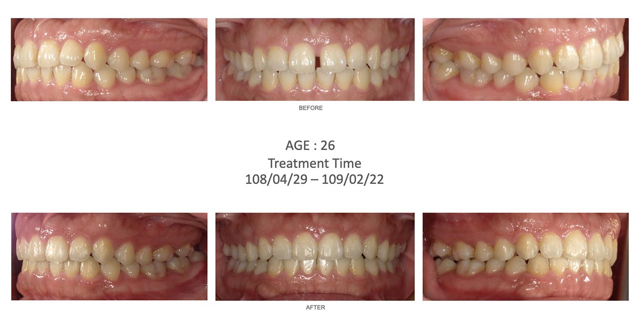隱適美Lite輕矯正前後咬合變化