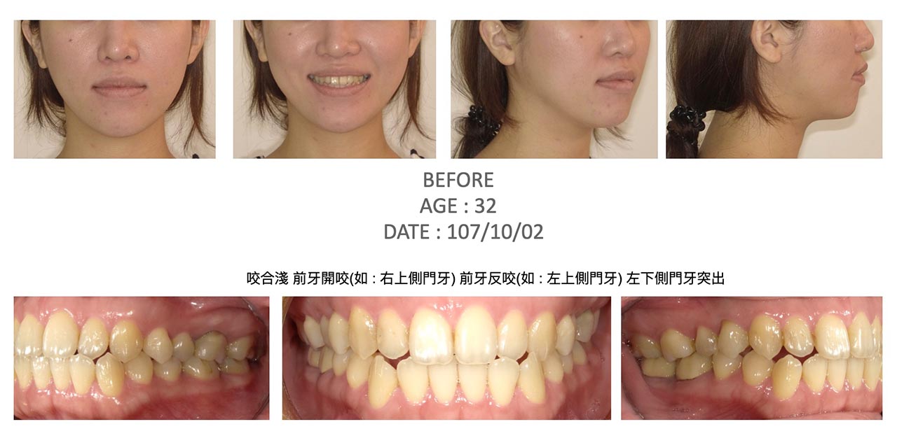 隱適美Lite輕矯正前的各角度臉型及咬合近照,有咬合淺、前牙開咬(如 : 右上側門牙)、前牙反咬(如 : 左上側門牙)、左下側門牙突出等問題
