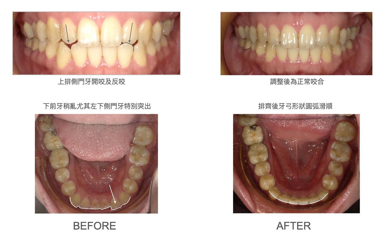 隱適美Lite輕矯正前後咬合與牙弓形狀變化,將上排側門牙開咬及反咬調整為正常咬合,並排齊下排牙齒使牙弓形狀圓弧滑順