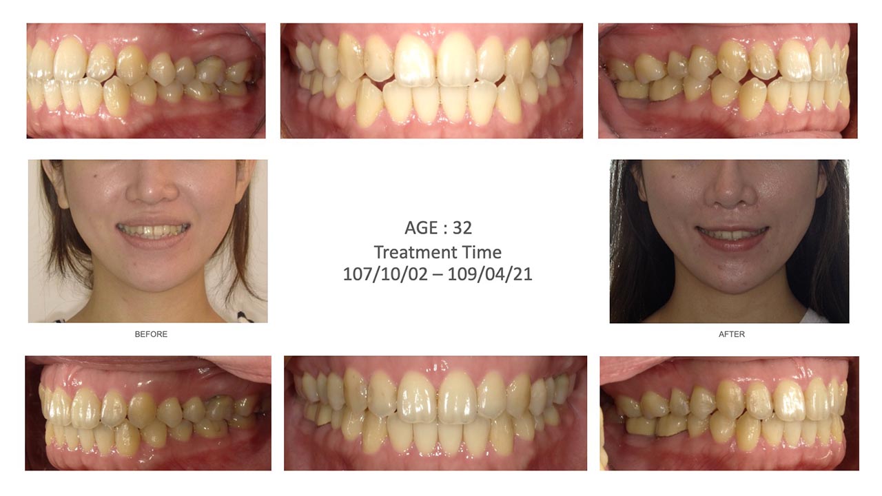 隱適美Lite輕矯正前後笑容臉型及咬合變化