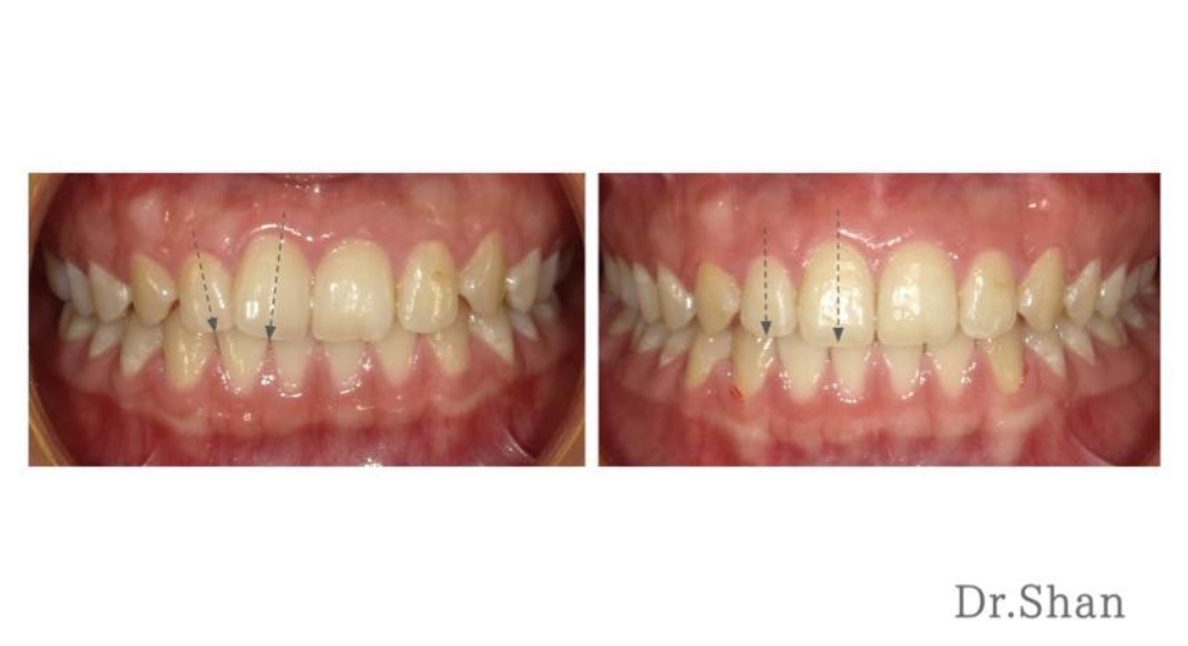 隱適美Lite輕矯正前後的前牙牙齒排列變化，不到一年的時間就改善輕微的上門牙不對稱