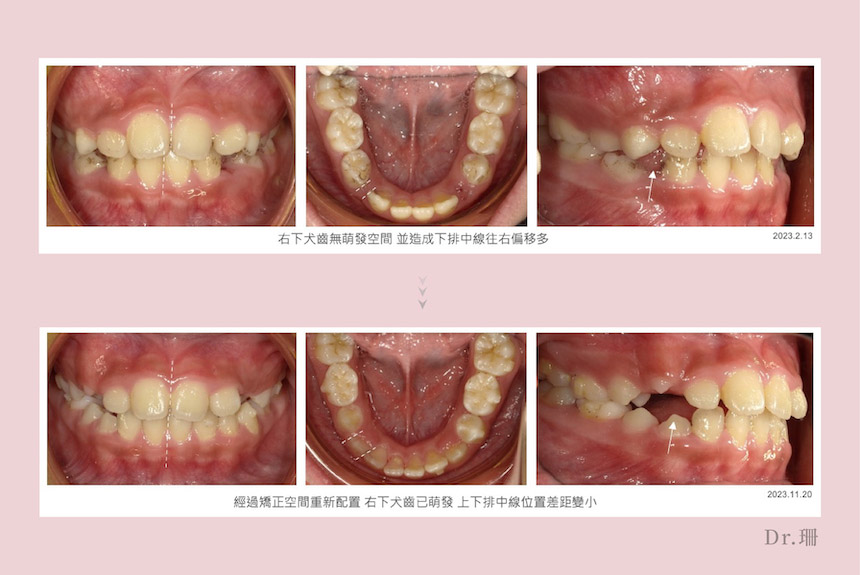 兒童牙齒矯正-兒童隱適美-隱形牙套-台中-隱適美-推薦-楊念珊醫師