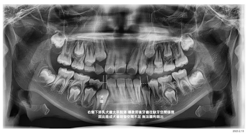兒童牙齒矯正-兒童隱適美-隱形牙套-矯正前X光片-台中-隱適美-推薦-楊念珊醫師