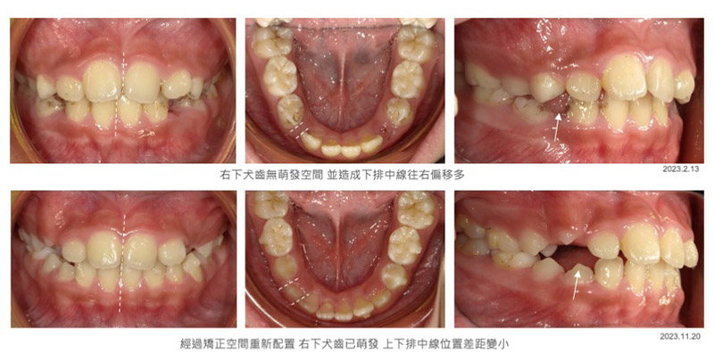 兒童牙齒矯正-兒童隱適美-隱形牙套-矯正前後牙齒對比-台中-隱適美-推薦-楊念珊醫師