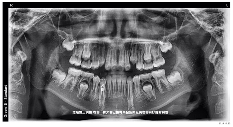 兒童牙齒矯正-兒童隱適美-隱形牙套-矯正後X光片-台中-隱適美-推薦-楊念珊醫師