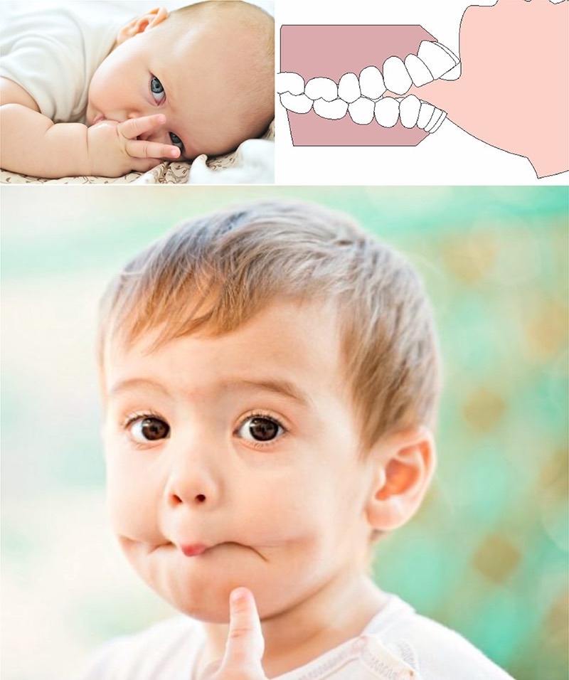 兒童不良口腔習慣：吸手指、咬下唇示意圖