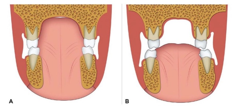 舌頭擺放位置正常會讓牙弓呈現U字型；舌頭位置太低則易造成牙弓狹窄
