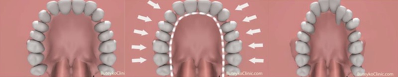 內外側力平衡時牙弓自然形成U字型；若失去力平衡則會導致牙弓狹窄形成門牙暴牙