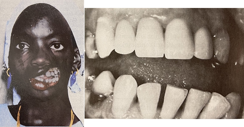 臉頰組織缺損影響力平衡，造成牙齒向外暴出的極端案例