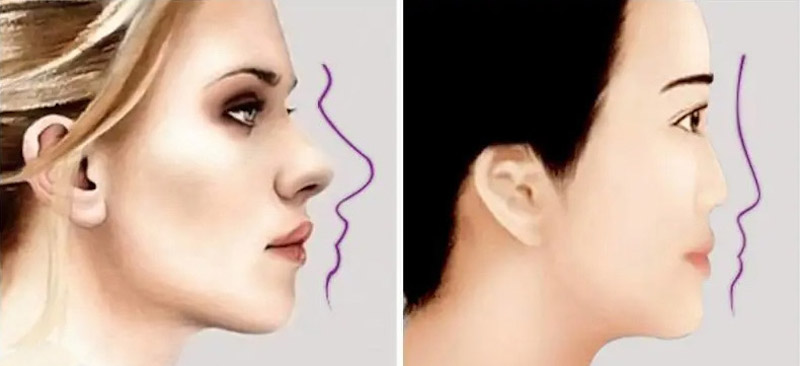 西方人與亞洲人臉型比較，西方人天生就有立體臉型