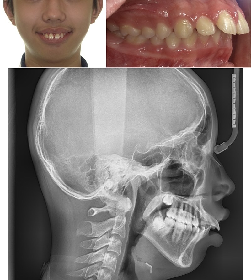 骨性暴牙+小下巴的外觀與側顱X光