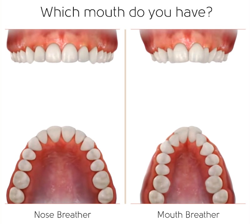 鼻呼吸與口呼吸影響牙弓形狀示意圖，口呼吸易導致牙弓形狀狹窄，往前推擠而形成暴牙