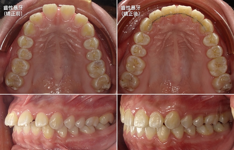 齒性暴牙矯正前後比較圖：矯正前牙弓較狹窄，門牙向前突出並出現牙縫；矯正後牙弓弧度變得圓滑，門牙角度內縮
