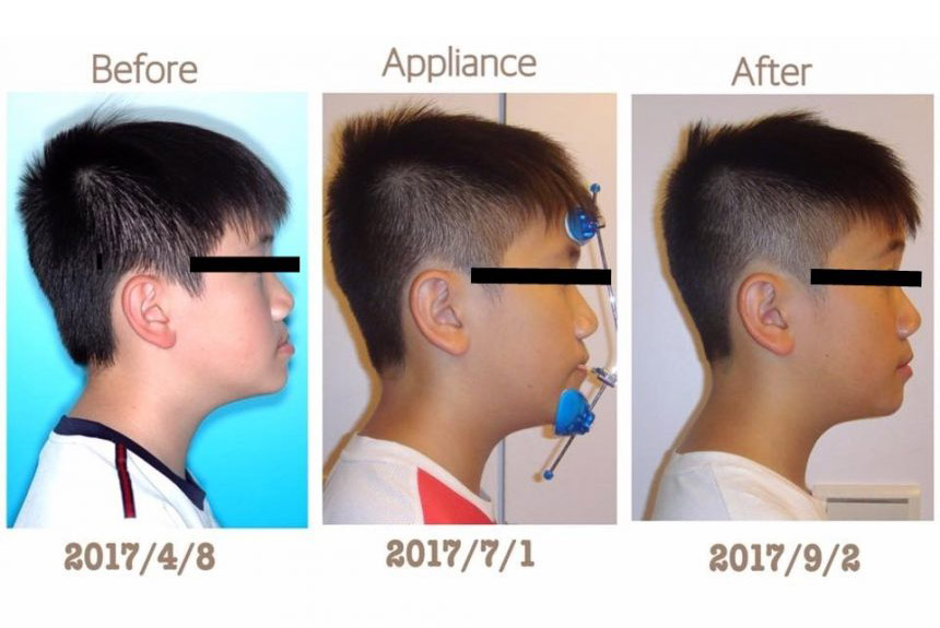 兒童戽斗矯正前後臉型變化