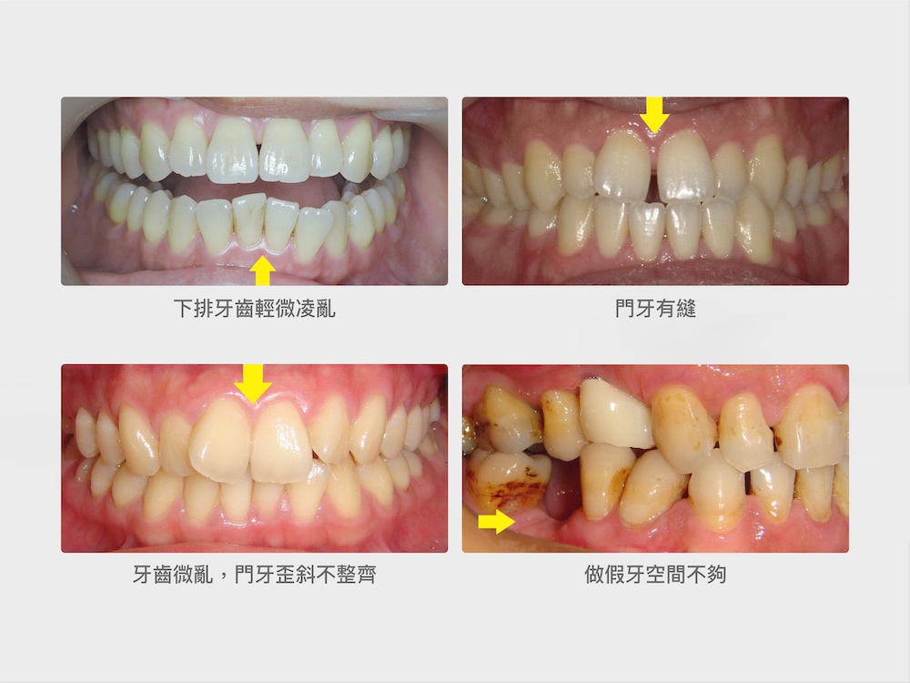 適合用隱適美Lite的情況示意圖,包含輕微牙齒亂、門牙縫、門牙歪斜不整齊、做假牙空間不夠等