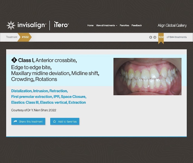 楊念珊醫師入選隱適美精選案例(Global Invisalign Gallery)