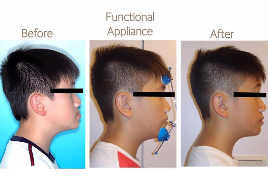 兒童戽斗矯正推薦案例-暑假兩個月改變孩子的臉型