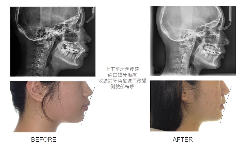 隱適美暴牙矯正前,上下前牙角度飛;拔牙矯正後,改善角度進而改變臉型輪廓
