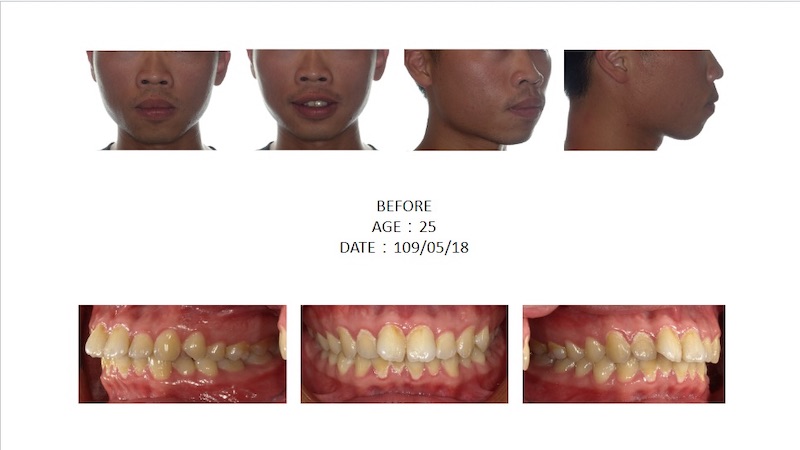 隱適美暴牙矯正前的各角度臉型及咬合近照,側臉輪廓嘴巴較凸,且有牙齒擁擠、深咬等問題