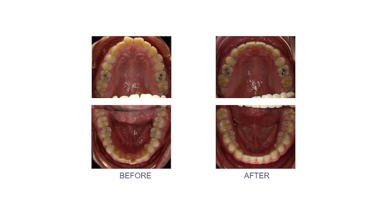 隱適美暴牙矯正前後上下排牙弓形狀變化:矯正前牙齒突出牙弓較窄;未使用骨釘進行拔牙矯正後,牙齒後退排整齊,牙弓呈現圓滑狀