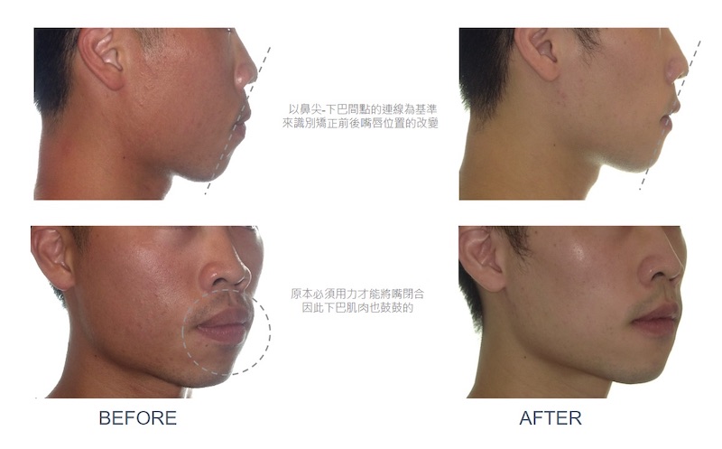 隱適美暴牙矯正前後臉型與嘴唇變化:嘴唇位置內縮,改善原本必須用力才能將嘴閉合的情況