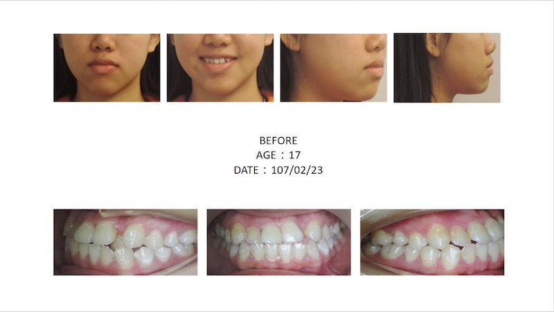 隱適美矯正前的各角度臉型及咬合近照,牙齒凌亂擁擠,側臉輪廓嘴巴較凸