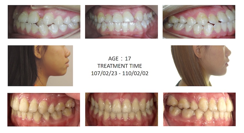隱適美矯正前後臉型及咬合變化,解決牙齒亂與擁擠,嘴唇後退改善側臉輪廓