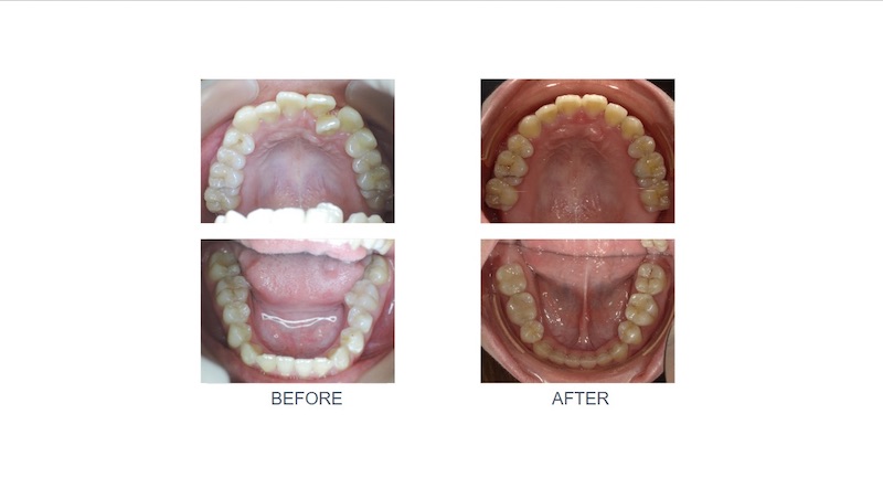 隱適美矯正前後上下排牙弓形狀變化:矯正前牙齒凌亂且擁擠;拔小臼齒矯正後排齊牙齒,牙弓形狀更圓滑