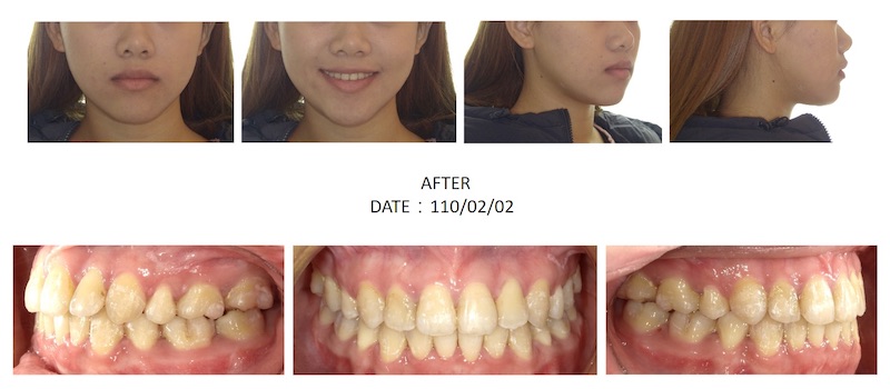 隱適美矯正後的各角度臉型及咬合近照,牙齒內縮排整齊也改善側面臉型輪廓