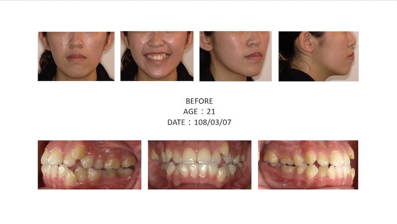 隱適美戽斗矯正的各角度臉型及咬合近照,下巴看起來較長,伴隨左上高犬齒(俗稱虎牙)、笑露牙齦、牙齒亂等問題