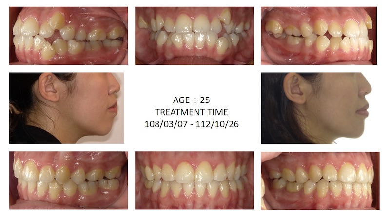 隱適美戽斗矯正前後臉型及咬合變化,拔牙矯正後牙齒變得整齊、輪廓線內縮,下巴臉型也變得更為平衡