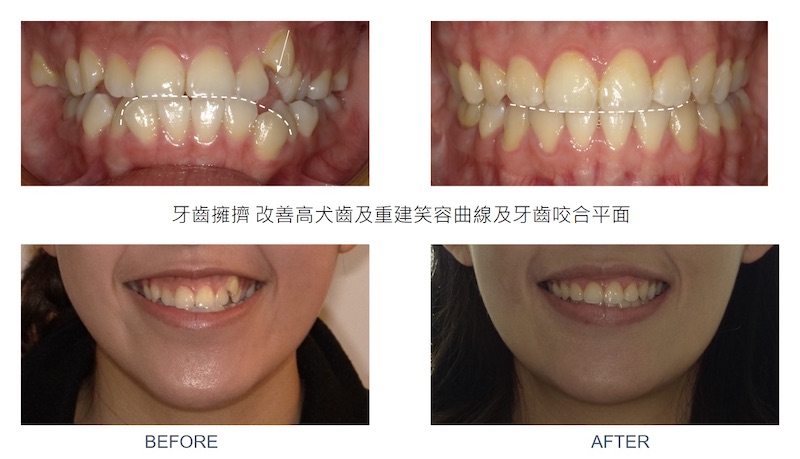 隱適美戽斗矯正前後正面咬合與微笑曲線變化,拔牙矯正後改善牙齒擁擠、高犬齒(虎牙),重建微笑曲線及咬合平面