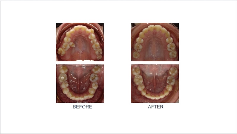 隱適美戽斗矯正前後上下排牙弓形狀變化:矯正前牙弓形狀擁擠不對稱;拔牙矯正後牙弓形狀呈現圓滑U型