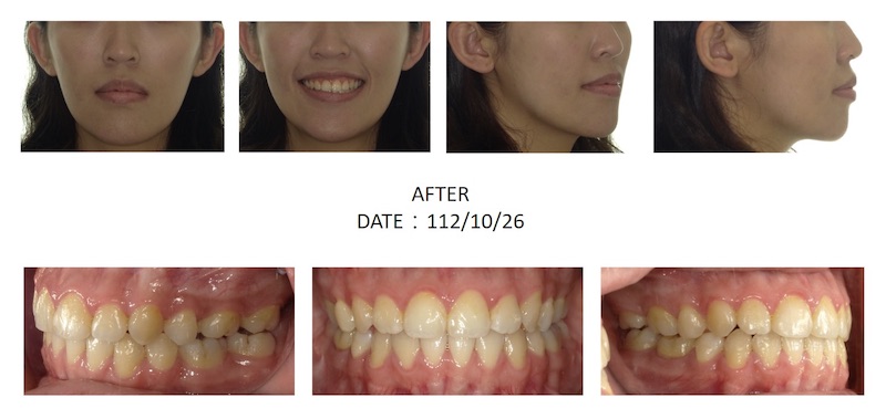 隱適美戽斗矯正後的各角度臉型及咬合近照,拔牙矯正後排齊牙齒,一併解決虎牙、笑齦等問題也改善側臉輪廓