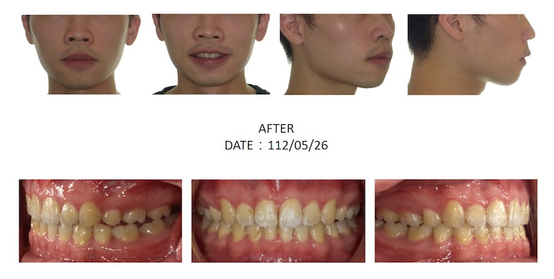 隱適美暴牙矯正後的各角度臉型及咬合近照,牙齒排整齊也改善側臉輪廓
