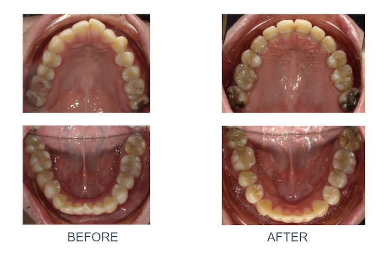 隱適美骨暴矯正前後上下排牙弓形狀變化:矯正前牙弓狹窄,上排前牙角度外飛嚴重且下排牙齒擁擠;拔牙矯正後,牙齒後退排整齊,牙弓呈現理想的圓滑形狀
