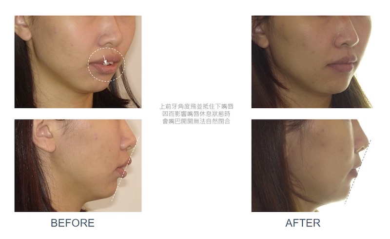 隱適美骨暴矯正前後臉型與嘴唇變化:矯正前上前牙角度飛並抵住下嘴唇,嘴巴無法自然閉合;拔牙矯正後,嘴唇可自然閉合並退到美觀線內