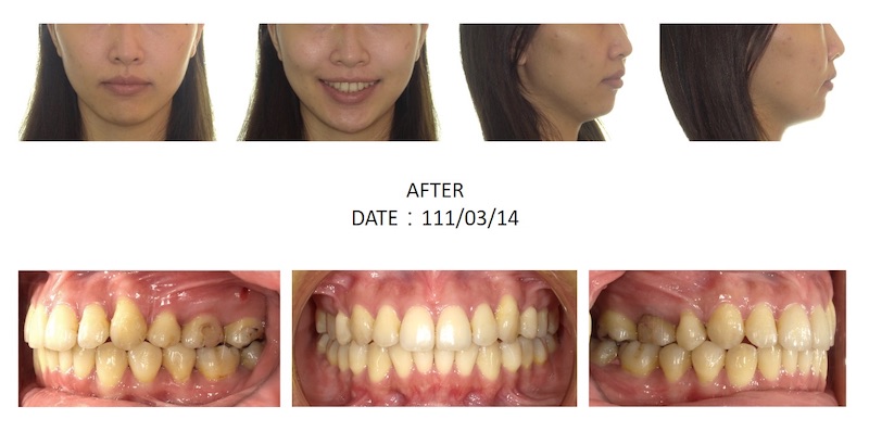 隱適美骨暴矯正後的各角度臉型及咬合近照,拔牙矯正後前牙內縮排整齊也改善側臉輪廓