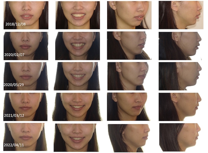 隱適美骨暴矯正過程的臉型外觀變化紀錄:原本因暴牙導致嘴唇無法自然閉合,側臉輪廓嘴巴較凸;拔牙歷經三年多矯正後嘴唇可自然閉合,臉型輪廓變得更漂亮