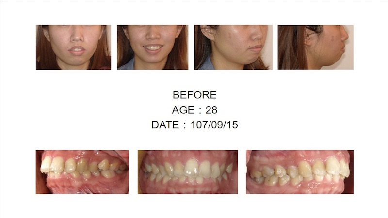 隱適美暴牙矯正前的各角度臉型及咬合近照,上排牙齒較突出且嘴唇無法自然閉合