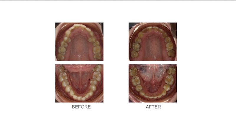 隱適美暴牙矯正前後上下排牙弓形狀變化:矯正前上排牙齒突出牙弓較窄;搭配骨釘進行拔牙矯正後,牙齒後退排整齊,擴大牙弓呈現理想的圓滑形狀